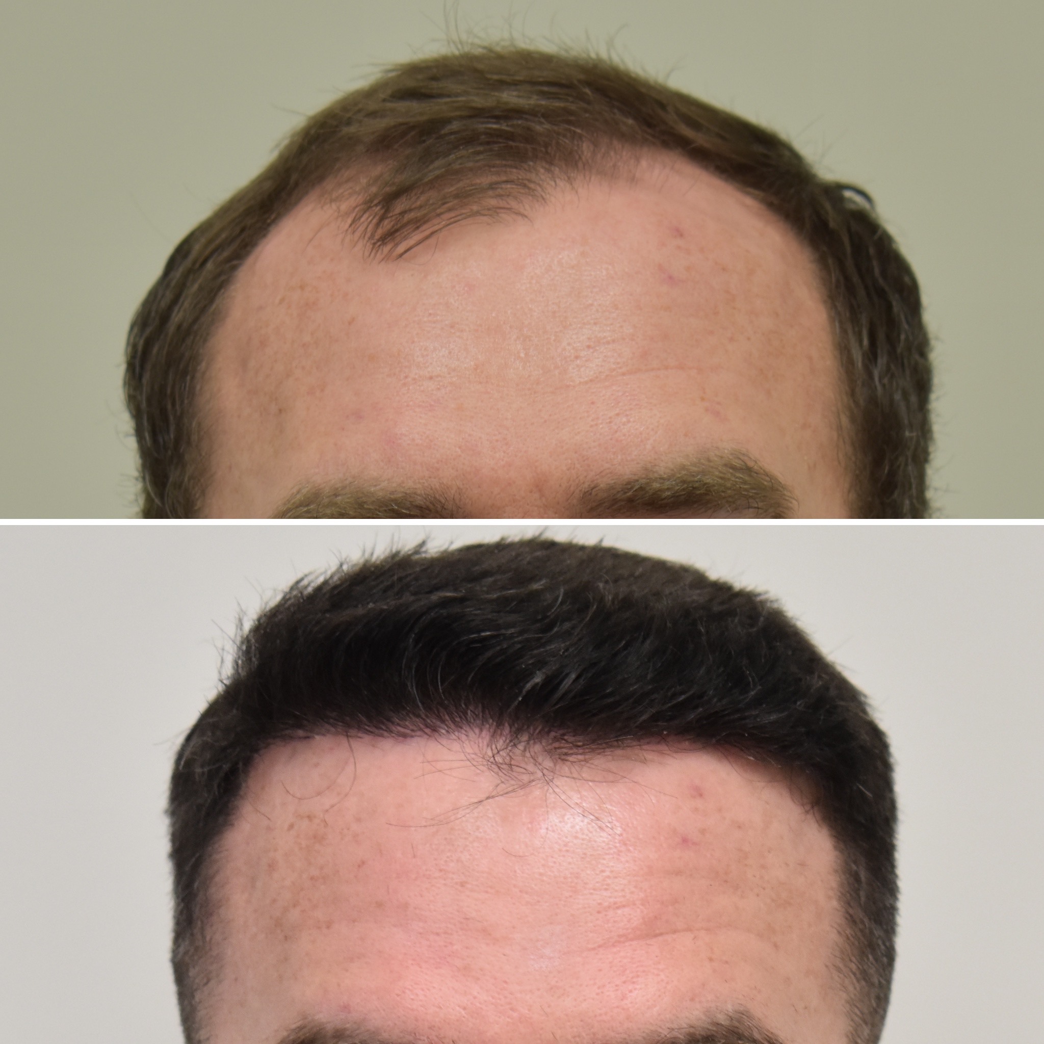 6 months post-FUE hair restoration to zones 1 and 2. Client received 3,000 grafts.