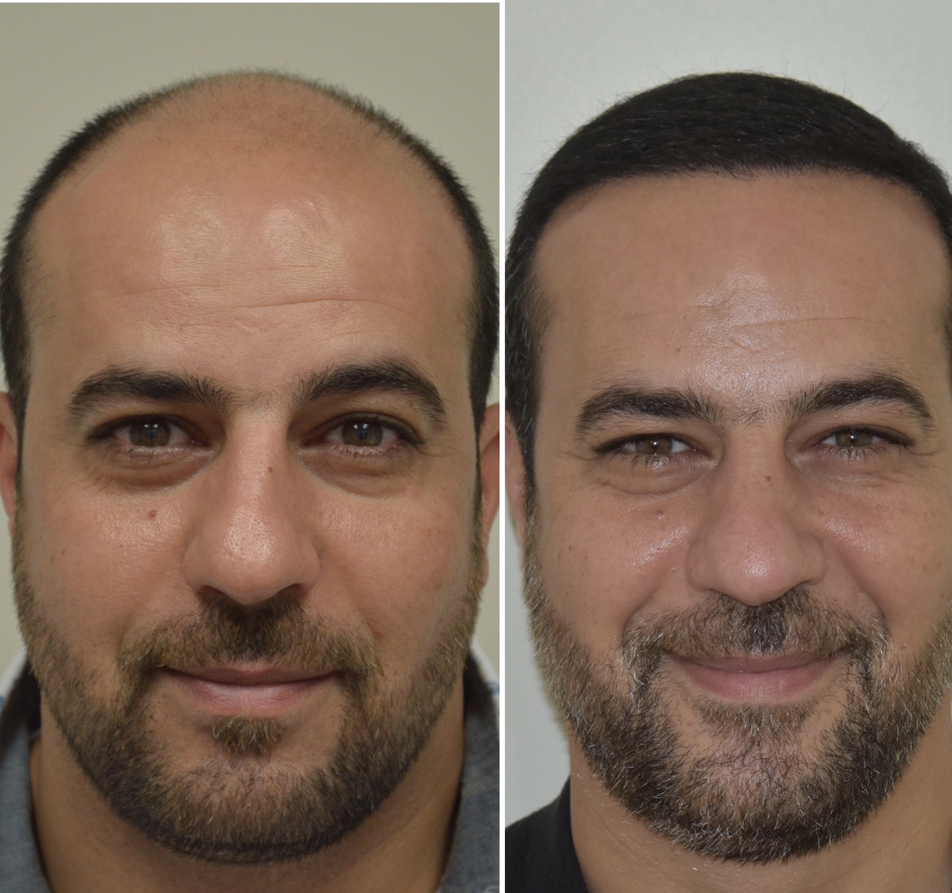 6 months post-FUE hair restoration to zone 1 and 2. Client received 4,000 grafts.