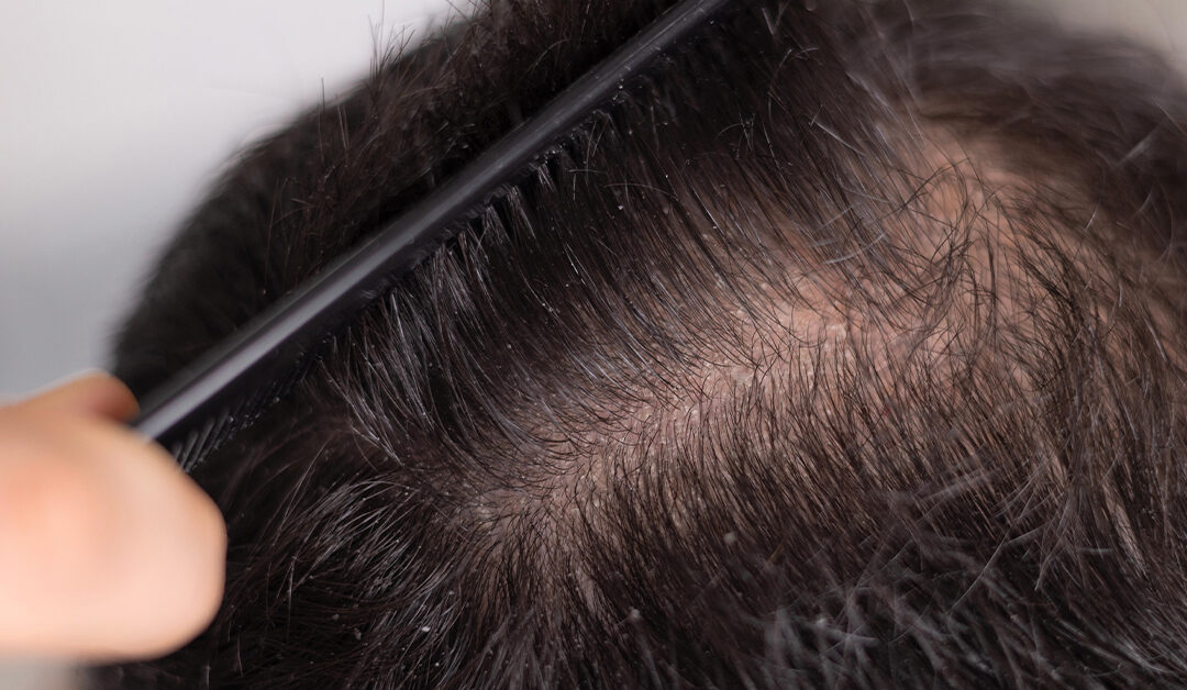 Combing hair to see the scalp