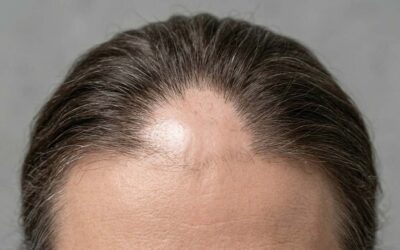 What Is Cicatricial (Scarring) Alopecia?