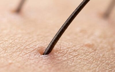 What Is a Hair Follicle?